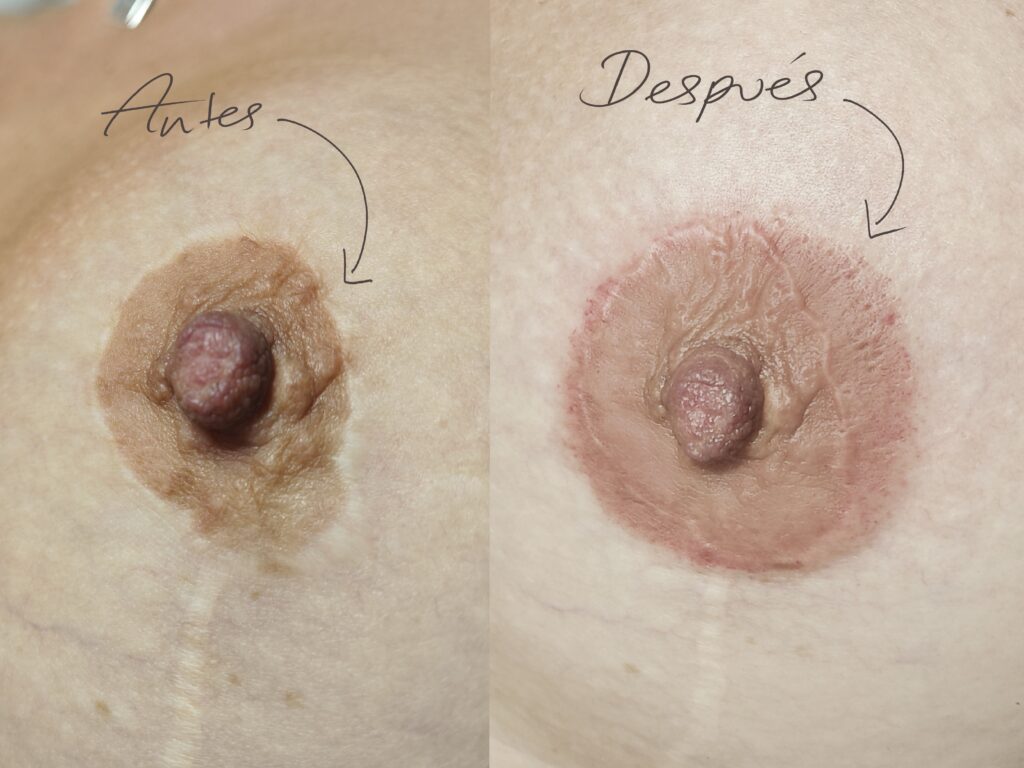 ejemplo real tatuaje reconstructivo 4583