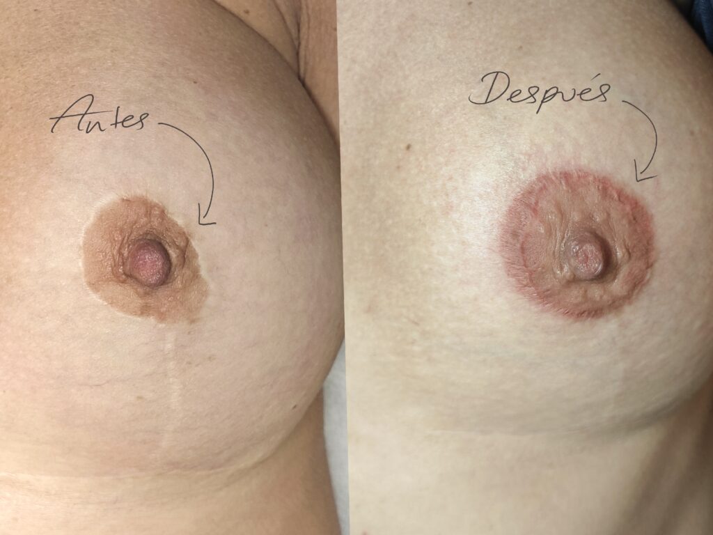 ejemplo real tatuaje reconstructivo 4584