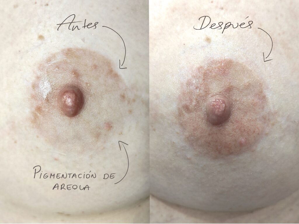 ejemplo real tatuaje reconstructivo 4586