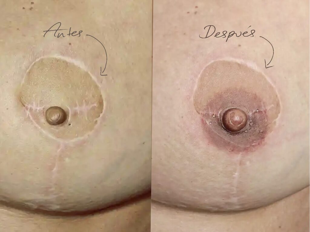 ejemplo real tatuaje reconstructivo 4614