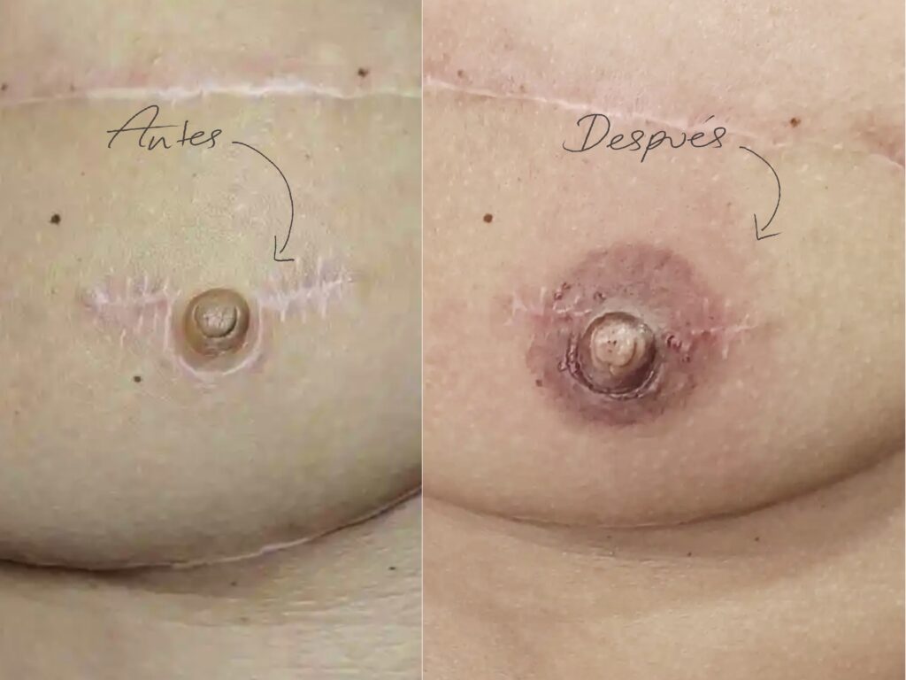 ejemplo real tatuaje reconstructivo 4616