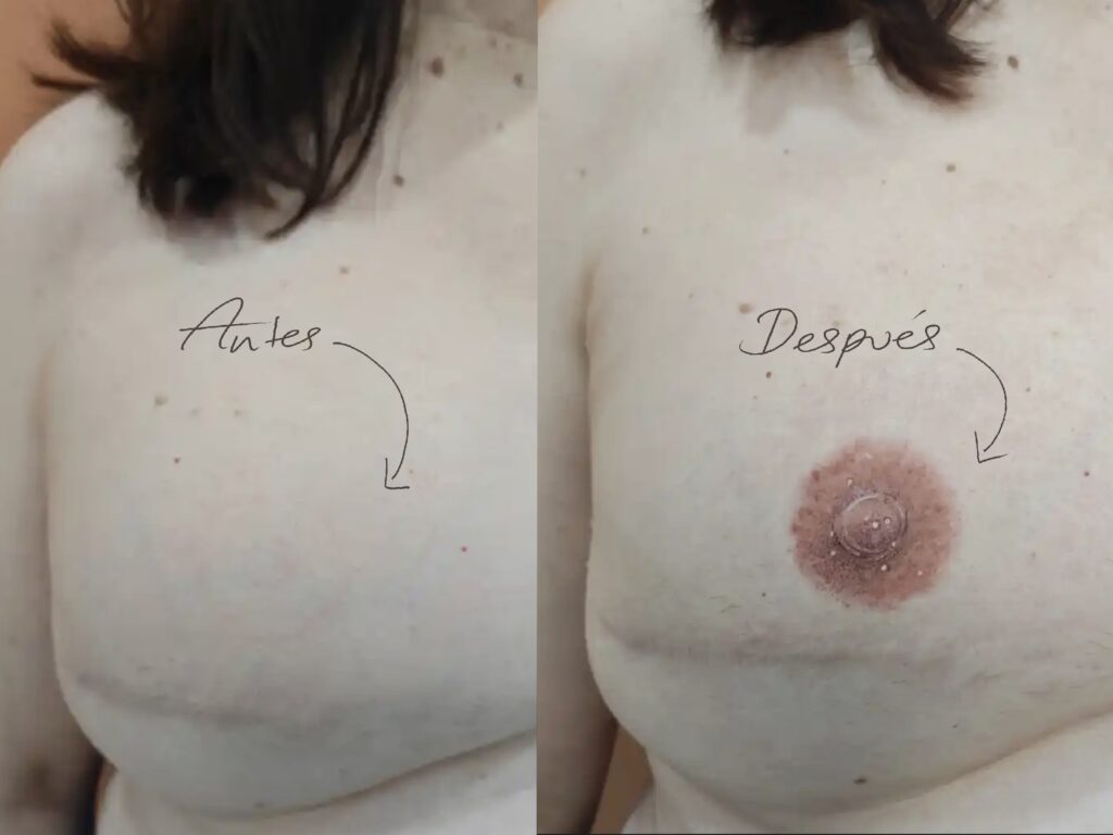 ejemplo real tatuaje reconstructivo 4617