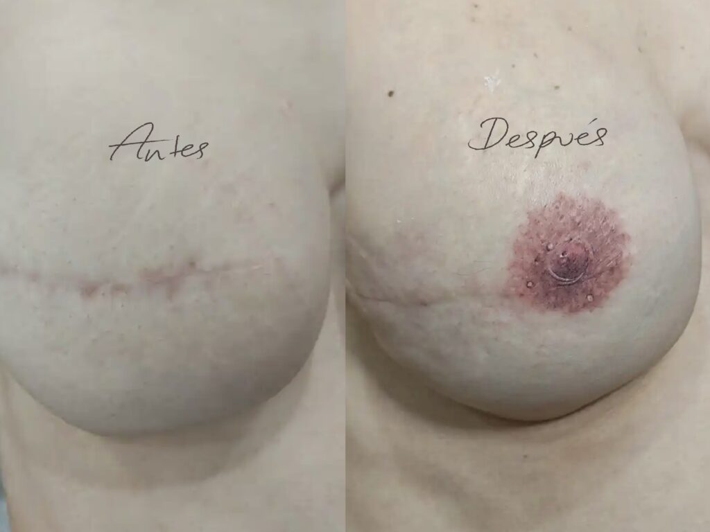 ejemplo real tatuaje reconstructivo 4626